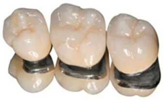 Протезирование зубов - металлокерамические коронки